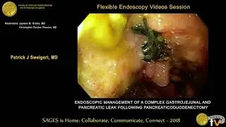 Endoscopic management of a complex gastrojejunal & pancreatic leak following pancreaticoduodenectomy