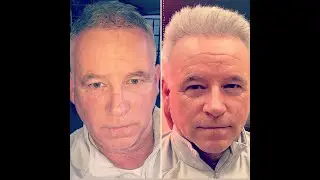 Are you bald? Self conscious about your thinning hair? Dr. Hill talks about how NeoGraft can help.