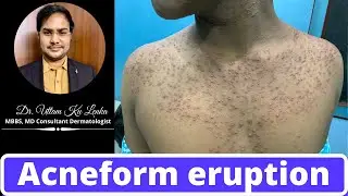 Treatment and reason of Pimples on body/Back(Acneform eruption) Sarir me pimples ka Karan aur ilaz
