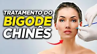 T&Eacute;CNICA EFICIENTE para TRATAR SULCO NASOGENIANO, o BIGODE CHIN&Ecirc;S