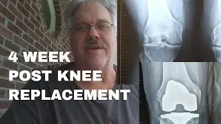This is a 4 week update after my total knee replacement surgery