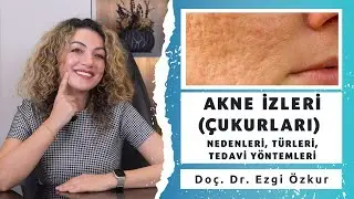 Akne İzleri (Çukurları) Nasıl Oluşur? Türleri ve Tedavi Yöntemleri Nelerdir?