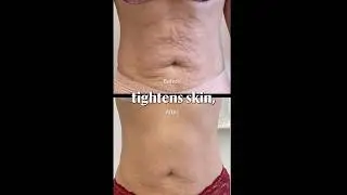 Try Tshape for loose skin & loss of muscle tone. ​⁠@CryoContouringStudioLLC @ArtemisDistribution