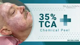 TCA Chemical Peel Unveiled: Transform Your Skin Today #chemicalpeels #tcapeel #acne #wrinkles