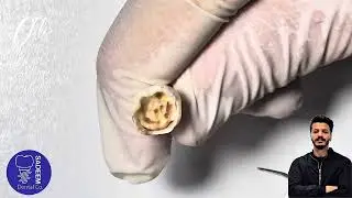 Access cavity in Destructive tooth 
