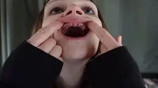 Full mouth extraction without immediate dentures update