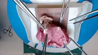 Arterial switch operation on silicone model of TGA 1L2RCx (Dr O Honjo) - 6th Annual HOST course