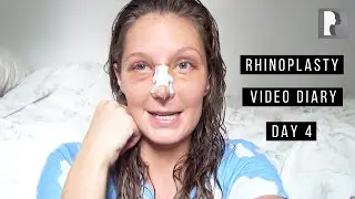 Rhinoplasty Video Diary - Day 4 After Surgery (3 of 15)