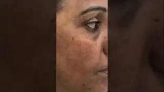 Glofara Cream Review| Glofara Skin Lightening Cream |2025 |Review भारत की No.1 Skin lightening cream