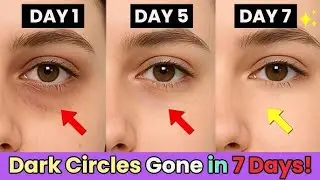 Dark Circles Gone in 7 Days 😱 | 2 Powerful Home Remedies That ACTUALLY Work!