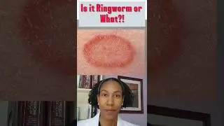 This is  NOT RINGWORM! Ringworm cream won't work! #skincare #skincondition