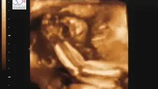 Sophie Lee Swinimer's Ultrasound