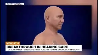 Испытания полностью имплантируемой системы Acclaim от производителя Envoy Medical