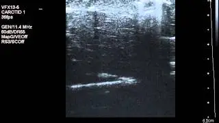 RF-MW Ablation on Ultrasound
