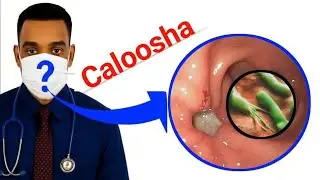 Gaas Calooleedka sida ugu fudud ee loo dabar jaro ama loo daaweeyo ✅ #Gaaska