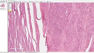 Leiomioma uterino / pólipo endometrial / hipotrofia endometrial