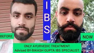 #ibskailaj #cureibs #irritablebowelsyndrome #BIKASHGUPTAIBS #IBSPERMANENTTREATMENT #संग्रहणी