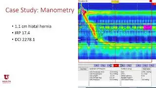The Role of Manometry Following Bariatric Surgery and Anti Reflux Surgery