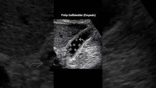 Polyp gallbladder//polip empedu #usg #radiology #polyps #gallbladder #batu #xray