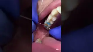 How We Fit Orthodontic Bands to make Orthodontic Expanders | Dr Bar The Braces Doc