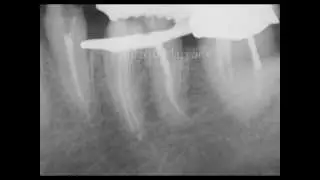 HyFlex CM: endodontic cases treated using a new Ni-Ti instrument