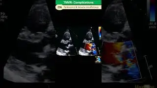 Prosthetic Valve Complications: Dehiscence, Paravalvular leakage, Endocarditis