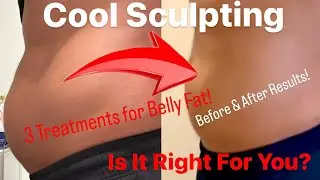 Michael Tried Cool Sculpting for the First Time... Should You?