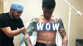 1 week post top surgery NB (Dr. Sassani)
