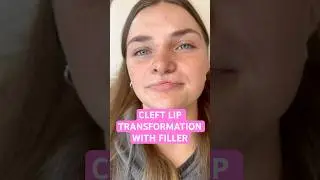 You will not BELIEVE this CLEFT LIP TRANSFORMATION! #cleftlip #cleftlipfiller #lipfiller