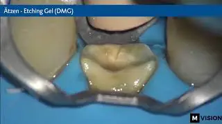 Post-endodontische Versorgung mit der LuxaCore Z Familie von DMG