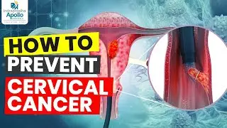 How To Prevent Cervical Cancer | Cervical Cancer Precaution And Treatment | Apollo Hospital