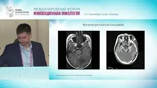 Дополнительная визуализация для определения объемов облучения  ПЭТ КТ, МРТ в помощь радиотерапевту.