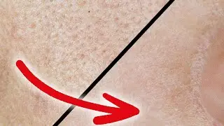 Gro&szlig;e Poren in Sekunden verschwinden lassen (klappt wirklich!)