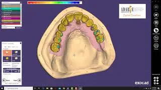 Hybrid Design with Exocad -Dr. Adarve