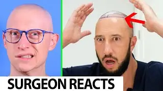 Hair Surgeon Reacts To Mike Majlak's Hairline