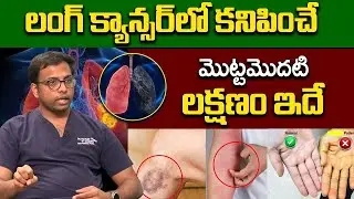 Lung Cancer: Types, Stages, Symptoms, Diagnosis & Treatment | Dr Ravi Teja | iDream