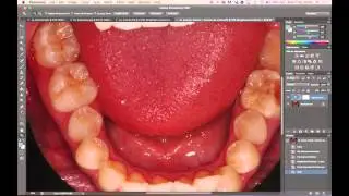 Tutorial de Edición de Fotografías Clínicas en Photoshop