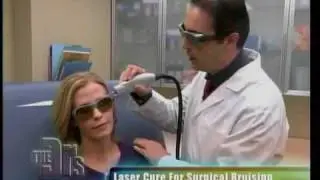 Candela Vbeam pulsed dye laser - an amazing treatment of bruising