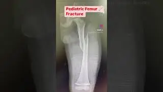 Pediatric Femur Fracture | #femur fracture #child #school #ytshorts #kids #bonefracture #reels