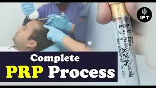 Complete PRP Process REVEALED! Hair Growth Miracle? 👀💉