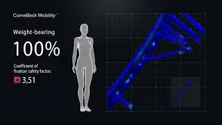 Individual weight-bearing prescription after Tibia fracture & plate fixation
