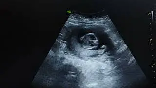 ASI SE VE UN EMBARAZO DE 13 SEMANAS DE GESTACIÓN VALORANDO TN Y HUESO NASAL
