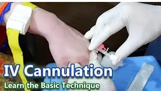 Intravenous (IV) Cannulation | OSCE guide | UKMLA | Plab 2 | USMLE | MRCP| Basic Clinical Skills 