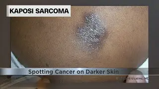 How to spot melanoma and other cancers on darker skin