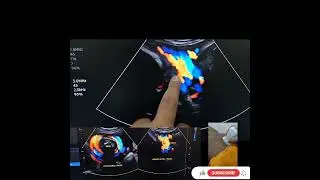 Technique probe angle in umbilical cord neck of fetus of usg. Twice loops the fetal neck.