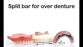Split bar for friction base over denture