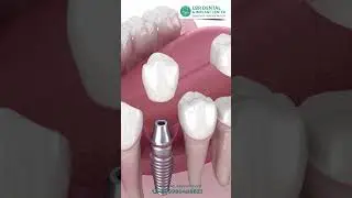 Don't Let Tooth Loss Change Your Face - Learn How to Keep Your Muscles Balanced! Best Dental Clinic