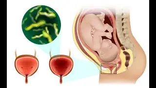 Klebsiella pneumoniae infections in Pregnancy; Matters in Pregnancy, Symptoms