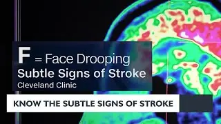 Know the subtle signs of a stroke