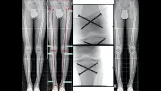Epiphysiodesis; orthopedic surgical procedure to halt growth at growth plate physis in long bone